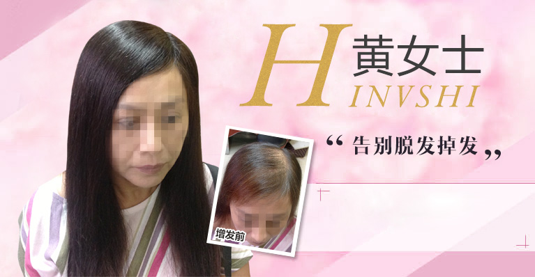 唐風采織發案例-眾多女性受頭發稀少