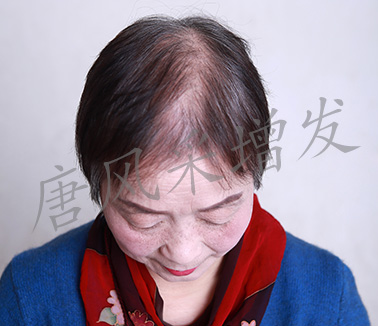 女士頭發稀少