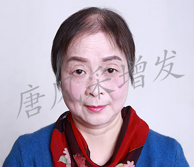 女士頭發稀少圖片