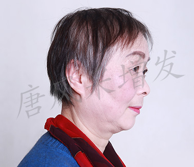 女士頭發稀少案例