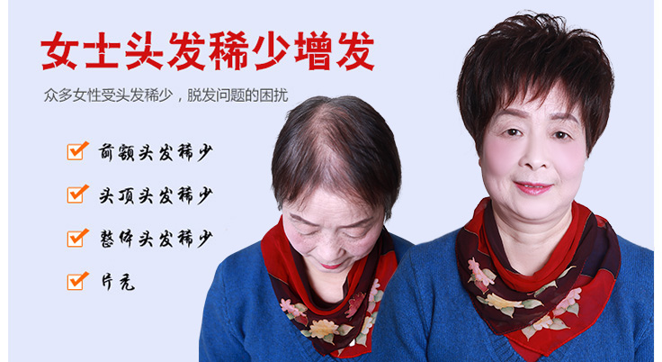 女士頭發稀少增發