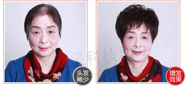 女士頭發稀少