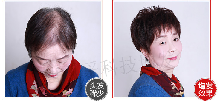 女士頭發稀少案例