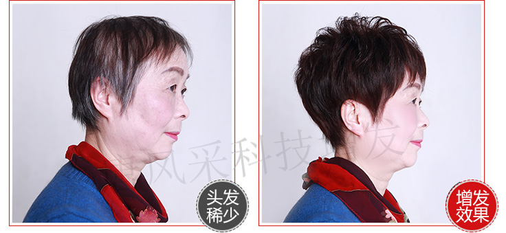唐風采女士頭發稀少增發
