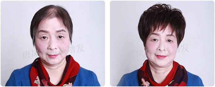 頭發稀少增發前后