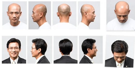廣州這邊禿頂怎么辦？可以修復么？