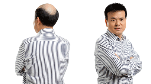 長沙頭掉頭發(fā)怎么辦？會脫發(fā)么？