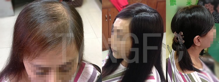 女士頭發稀少
