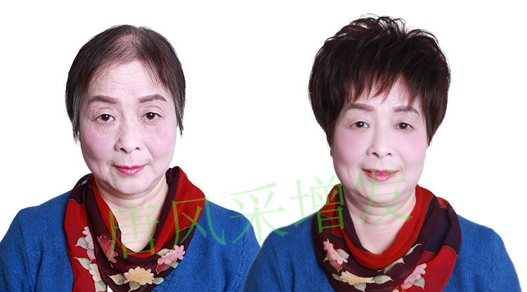 女士頭發稀少