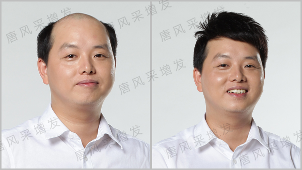 白發織發 白發脫發可不可以進行織發?