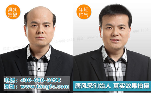 禿頂補發(fā)就選唐風采補發(fā)機構(gòu) 禿頂補發(fā)就選唐風采補發(fā)機構(gòu)