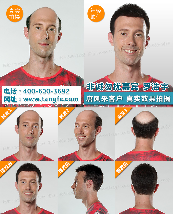 脫發(fā)真的沒(méi)救了嗎 脫發(fā)真的沒(méi)救了嗎?教你如何逆襲