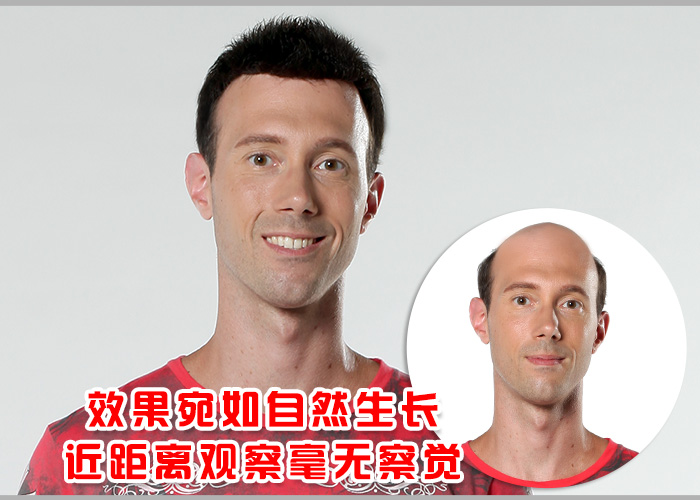 補發(fā)會掉嗎 禿發(fā)可以補發(fā)嗎?補發(fā)會掉嗎?