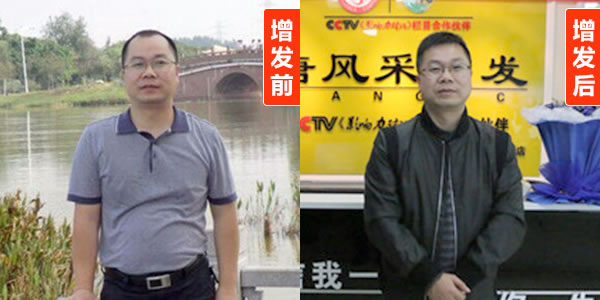 頭發(fā)再生的方法 頭發(fā)再生的方法有哪些?看了你就知道了!