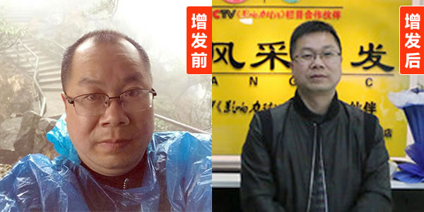頭發(fā)再生的方法有哪些 頭發(fā)再生的方法有哪些?看了你就知道了!