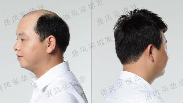 脫發(fā)補(bǔ)發(fā) 脫發(fā)后怎么辦?脫發(fā)補(bǔ)發(fā)也許是你最好的選擇!