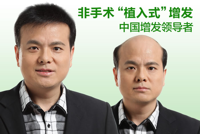 頭發(fā)稀少用什么 頭發(fā)稀少用什么?預(yù)防與解決需要懂這些
