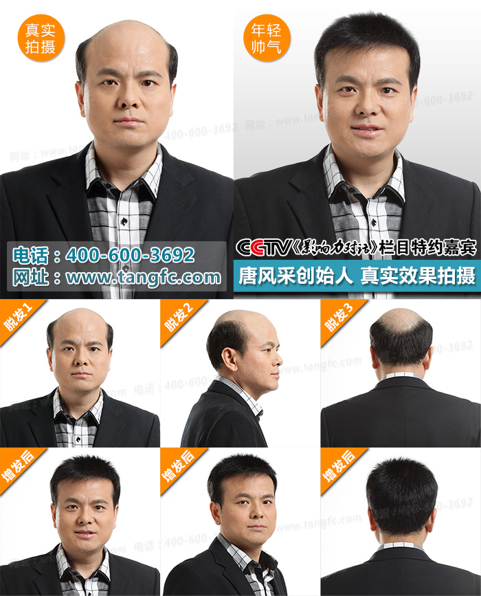 告別禿頂 唐風采增發用戶專訪:告別禿頂,自信生活從此開始