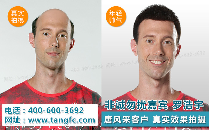 揭密掉發嚴重怎么辦？看這里