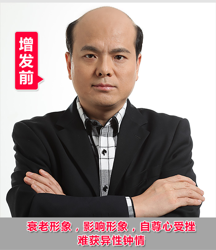 佛山假發(fā)專賣店 脫發(fā)禿頂?shù)目诵恰鹕剿饺硕ㄖ聘叨思侔l(fā)!