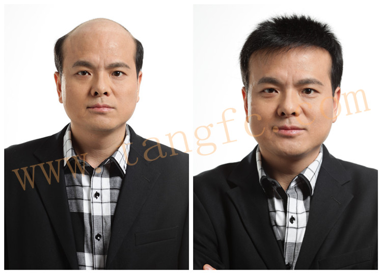 廈門頭發(fā)稀少如何解決？人為什么會(huì)脫發(fā)
