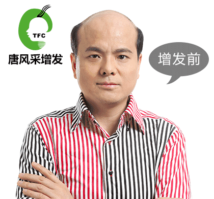 脫發頻繁 脫發頻繁容易抑郁 白領過勞現象叢生