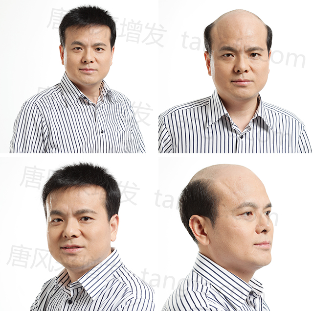 佛山哪里有織發(fā)補(bǔ)發(fā) 佛山哪里有織發(fā)補(bǔ)發(fā)?禪城區(qū)雅庭國際有