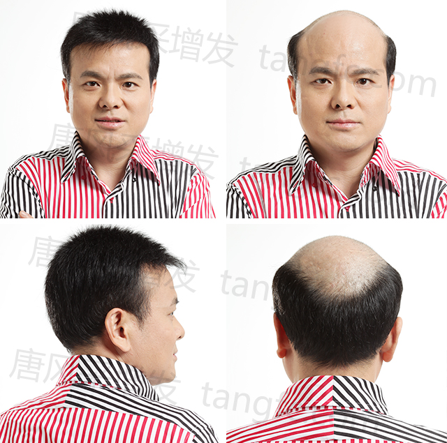 佛山假發(fā)專賣店 脫發(fā)禿頂?shù)目诵恰鹕剿饺硕ㄖ聘叨思侔l(fā)!