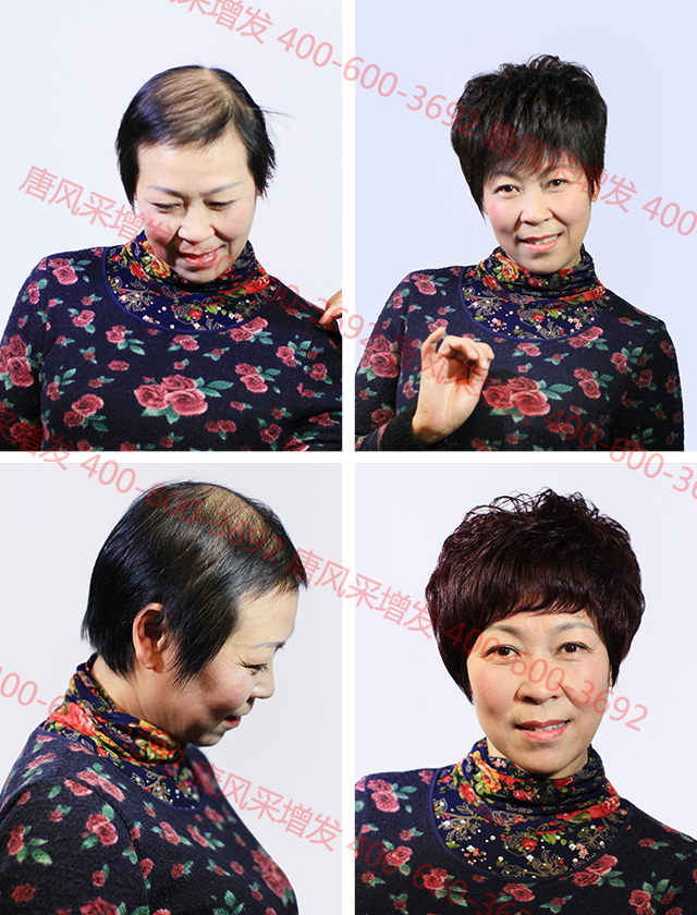 合肥織發定制解決脫發,什么品牌值得信賴?
