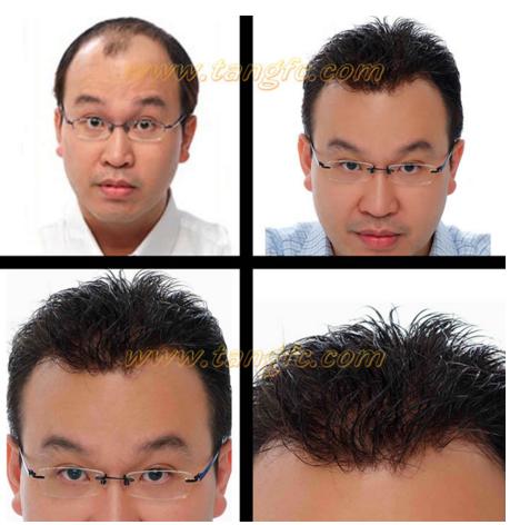 禿頂有救了 來自NASA的黑科技生發(fā)頭盔,禿頂有救了?