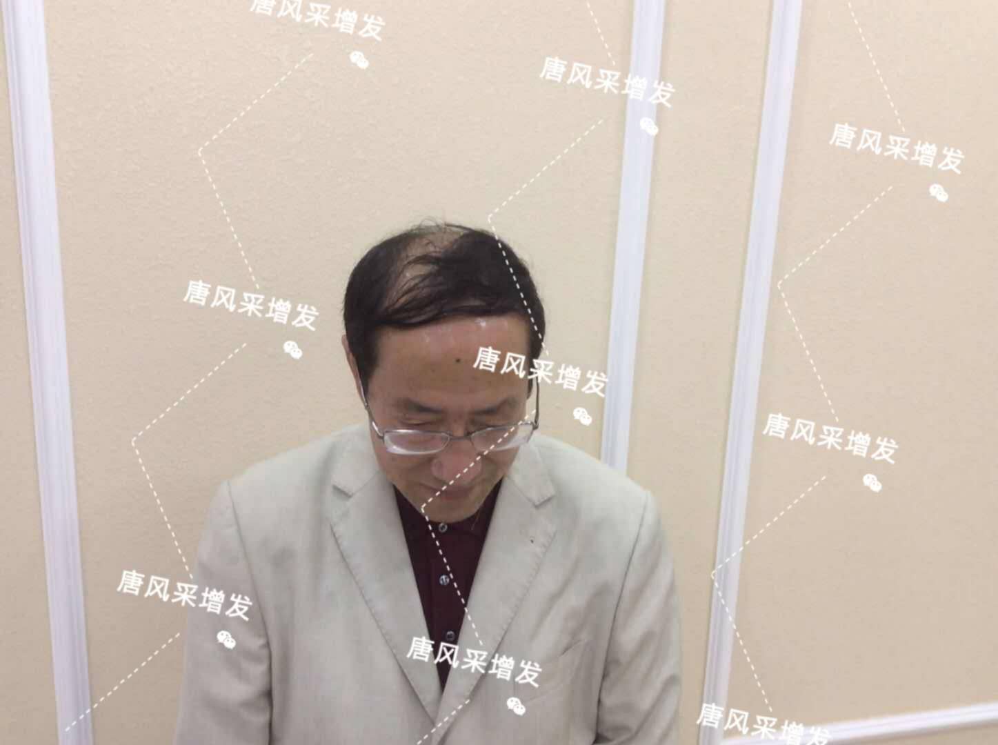 脫發禿頂成中年男人標配 脫發禿頂成中年男人標配?唐風采增發讓您風采始終如一