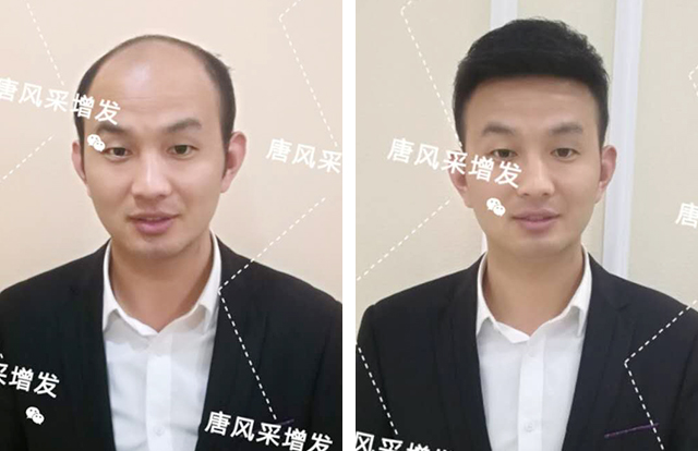 輸了頭發不能輸氣質 輸了頭發不能輸氣質,看帥哥的逆襲之路!