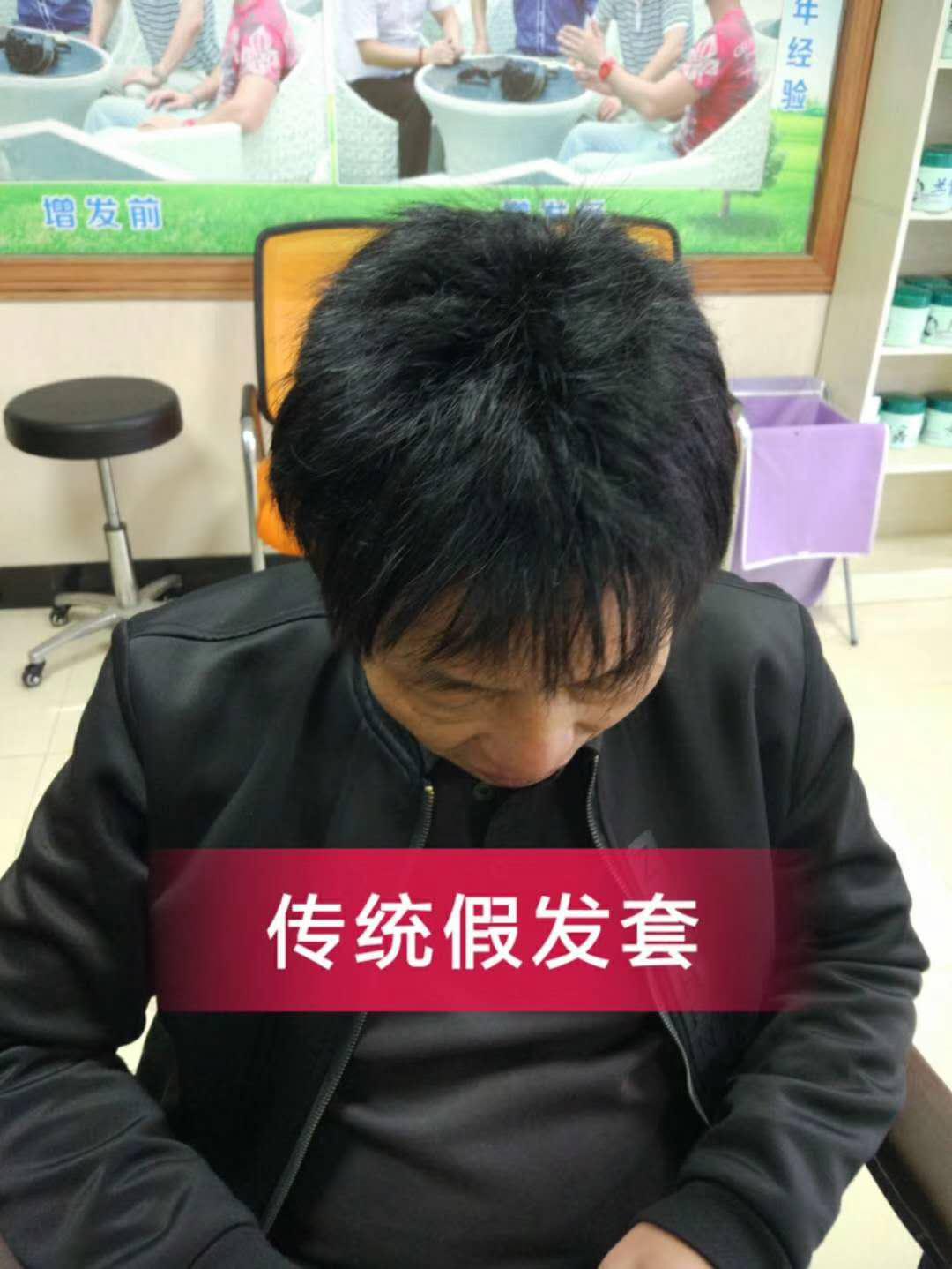 脫發(fā)謝頂 脫發(fā)謝頂壓力大,增發(fā)補(bǔ)發(fā)一身輕!