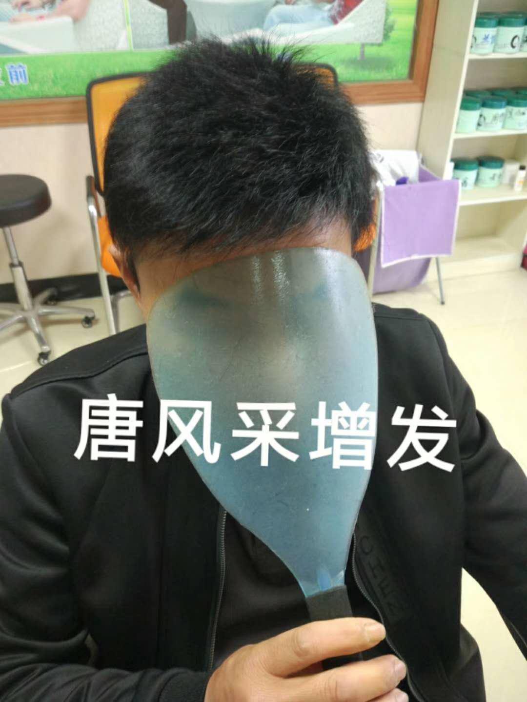 脫發(fā)謝頂 脫發(fā)謝頂壓力大,增發(fā)補(bǔ)發(fā)一身輕!