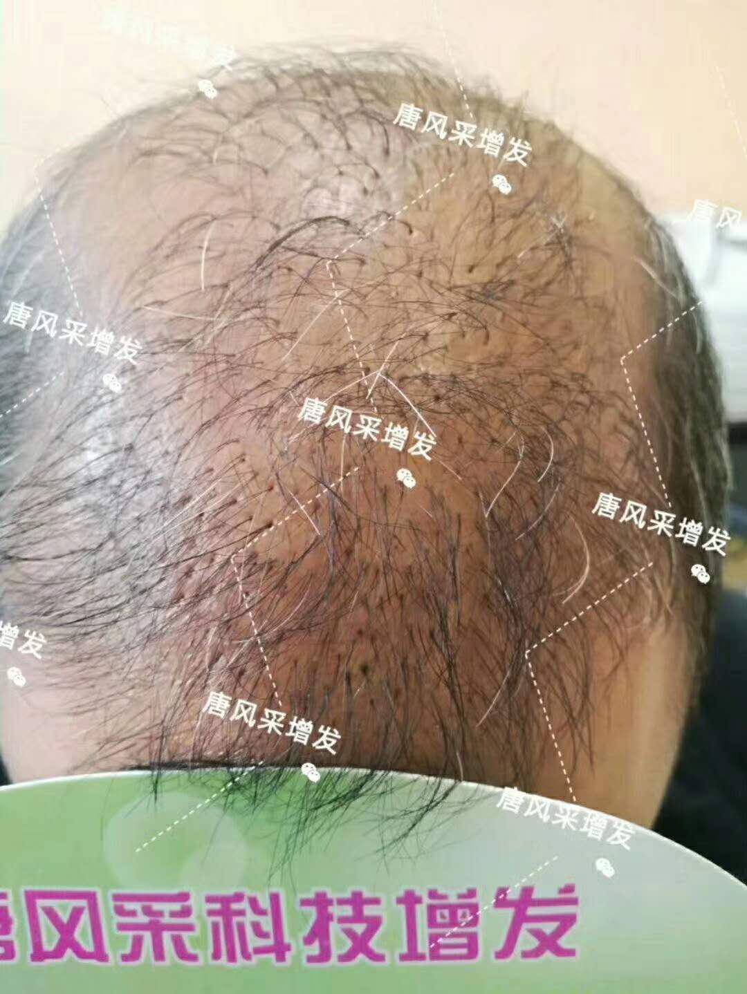 脫發(fā)謝頂 頭發(fā)稀少怎么變密?