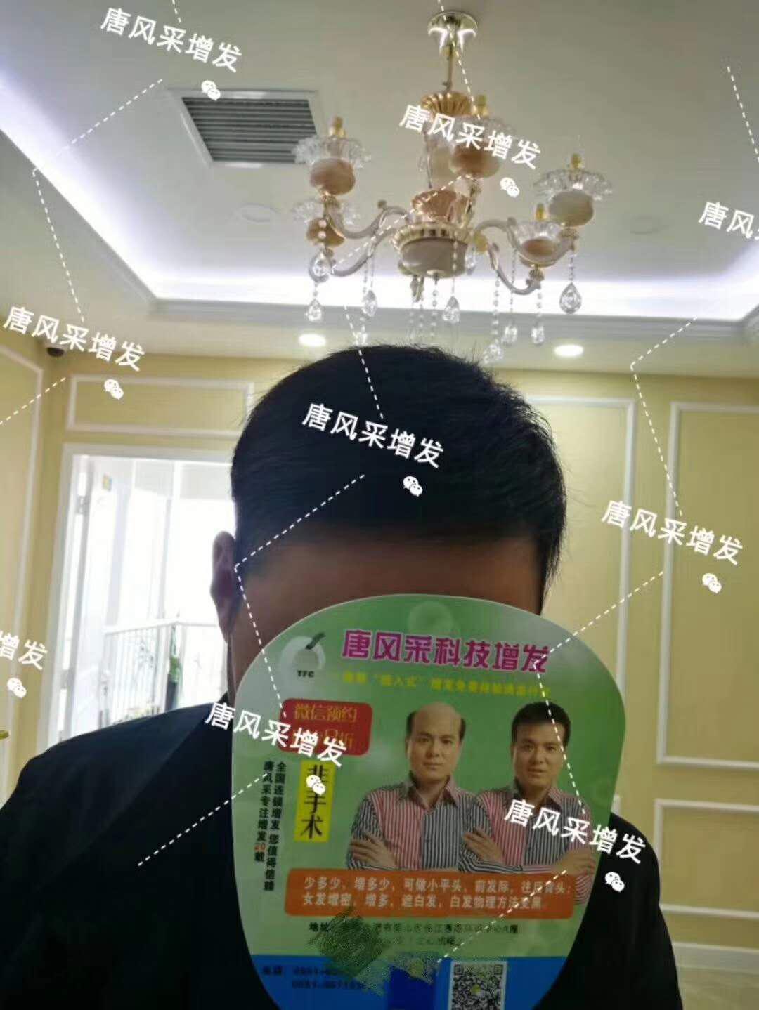 脫發(fā)謝頂 頭發(fā)稀少怎么變密?