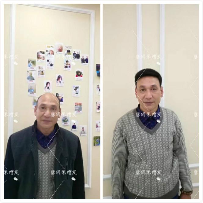 頭發少怎么辦？