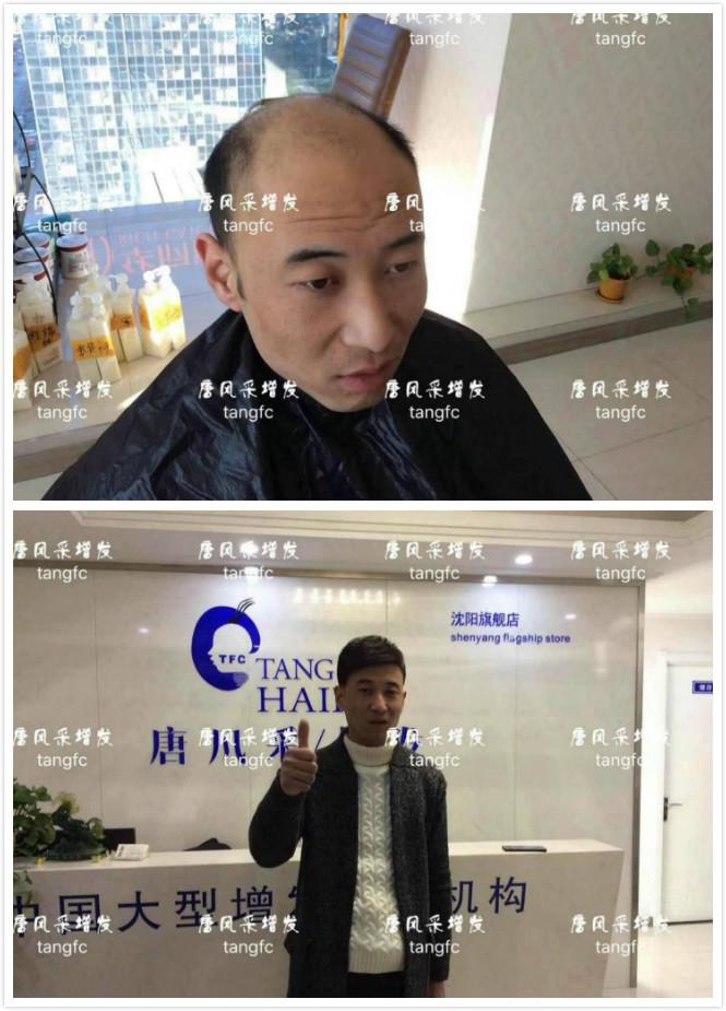 為脫發者解千愁，增發前后的驚人對比！