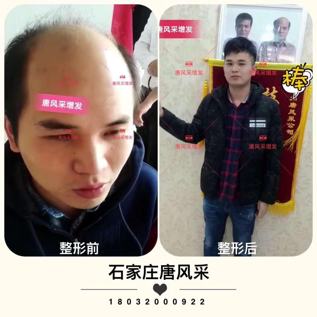 頭發少怎么辦？