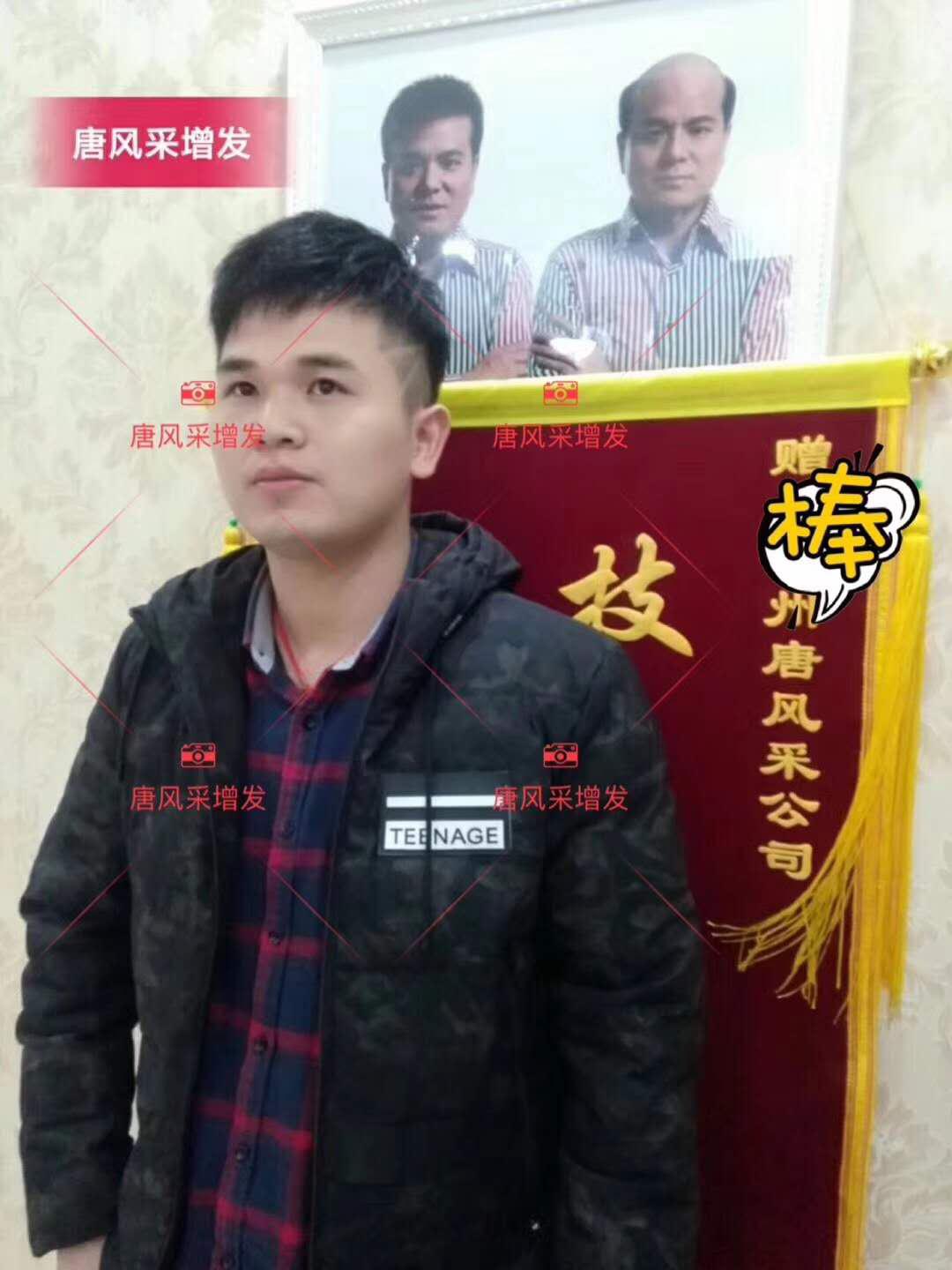 為脫發者解千愁，增發前后的驚人對比！