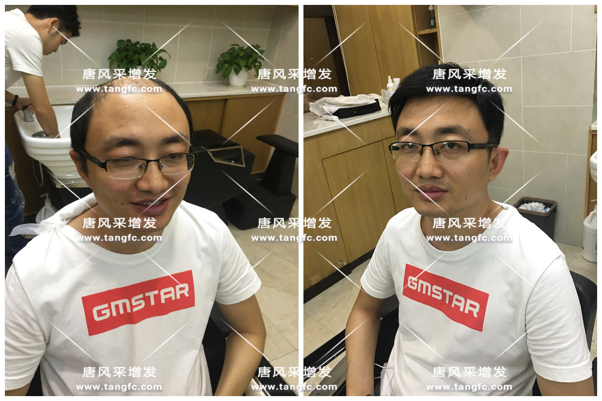 謝頂 謝頂會坑一輩子? 我不禁摸了摸自己頭發