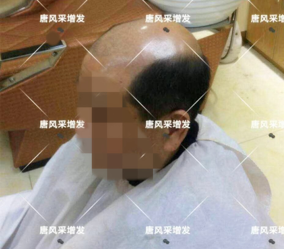 男人脫發原因 男人脫發原因多,不能一味怨腎虧!