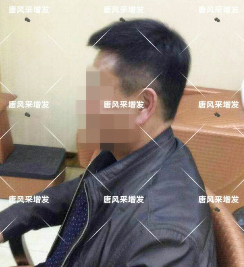 男人脫發原因 男人脫發原因多,不能一味怨腎虧!