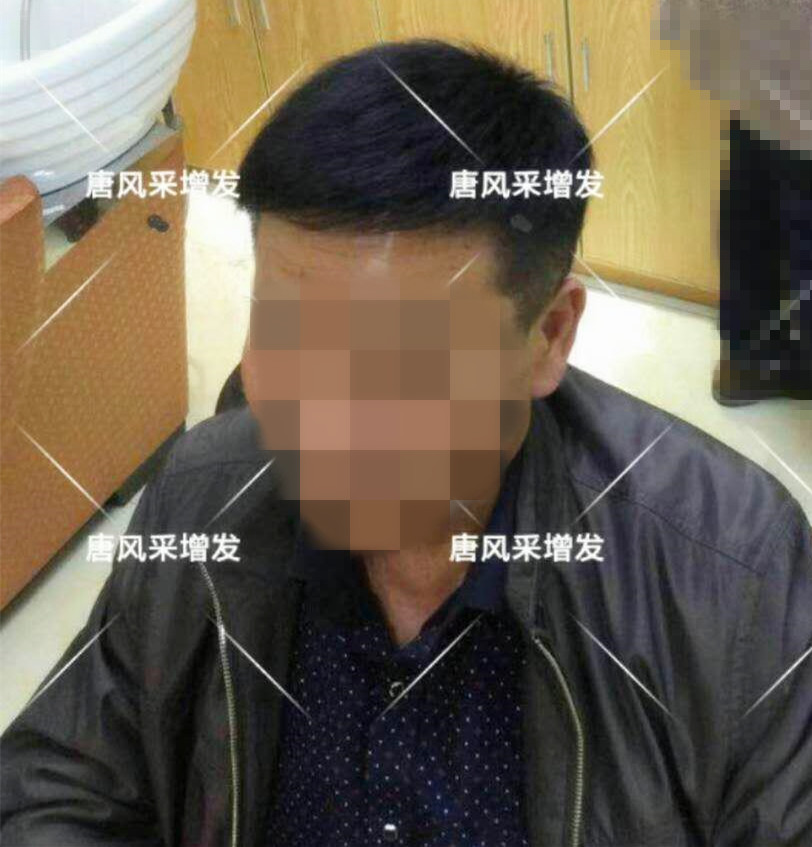 男人脫發原因 男人脫發原因多,不能一味怨腎虧!