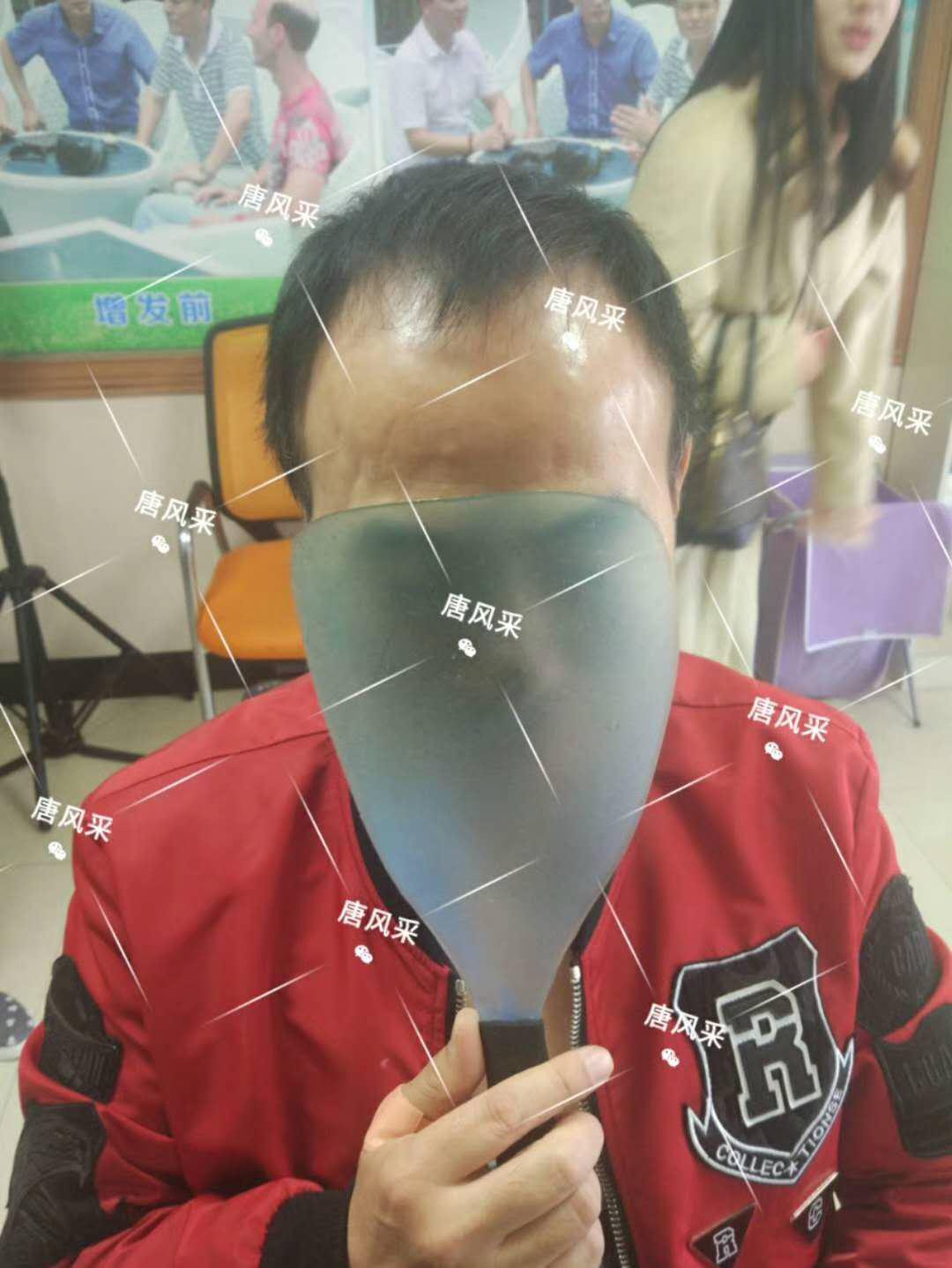 男人脫發原因 男人脫發原因多,不能一味怨腎虧!
