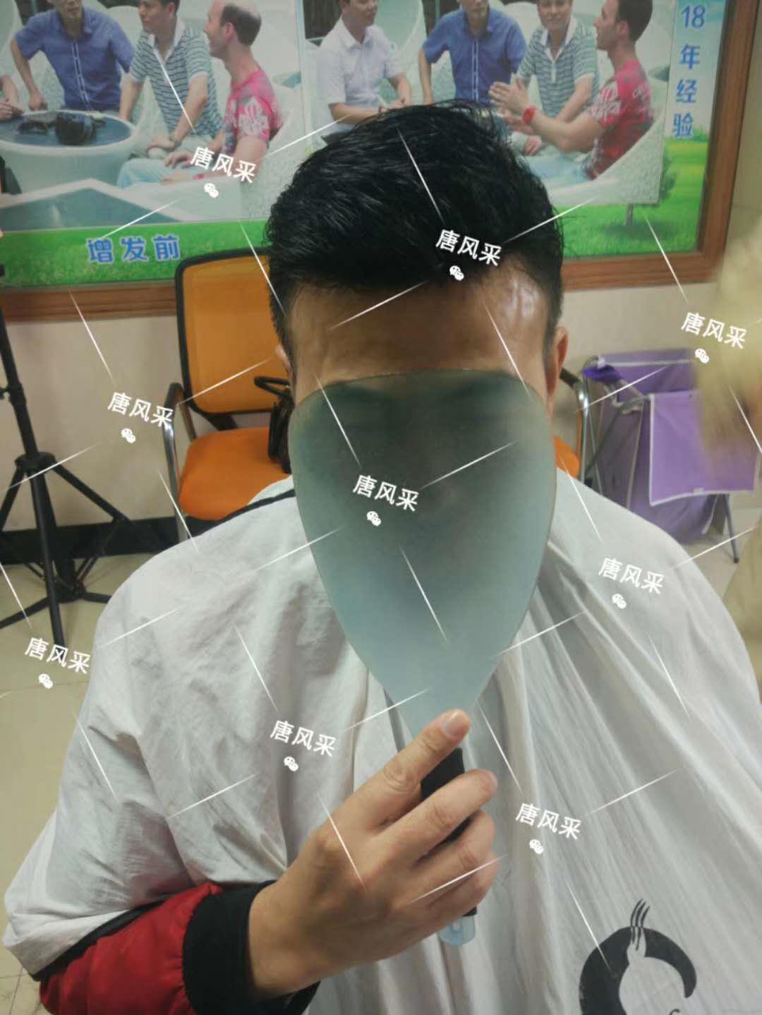 男人脫發原因 男人脫發原因多,不能一味怨腎虧!