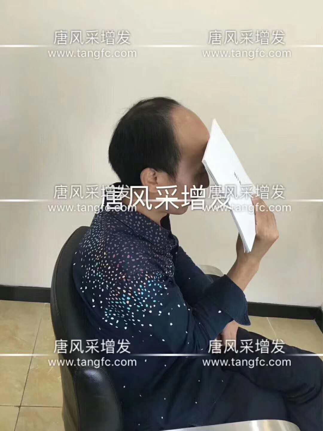 脫發人群 你想知道的所有事,時間會替我告訴你!