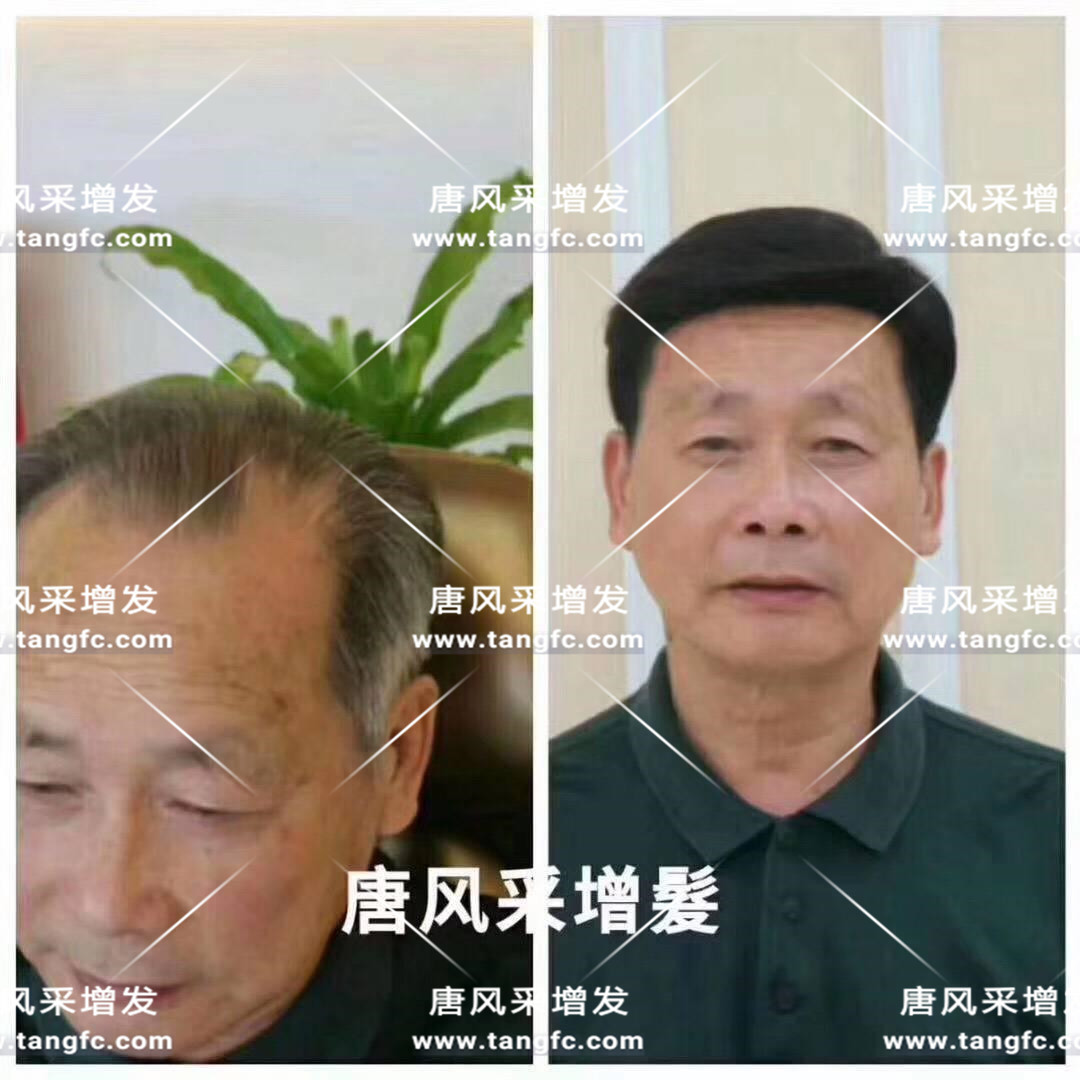 脫發人群 你想知道的所有事,時間會替我告訴你!