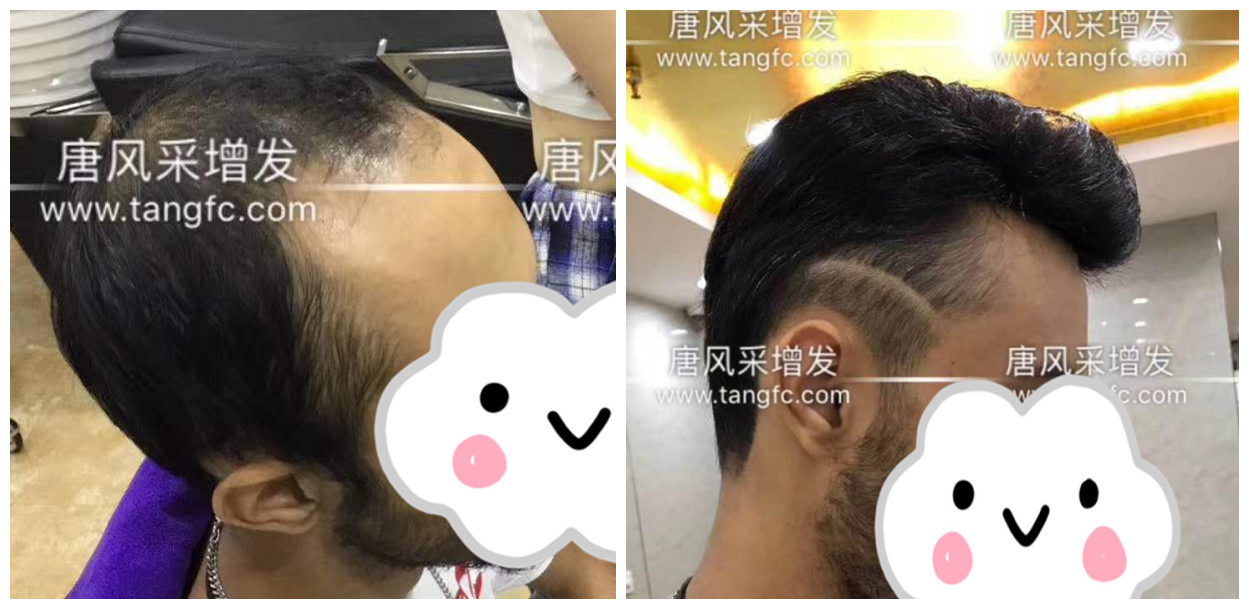 男士假發容易看出來嗎 男士假發容易看出來嗎?看看做過頭發的發友怎么說!