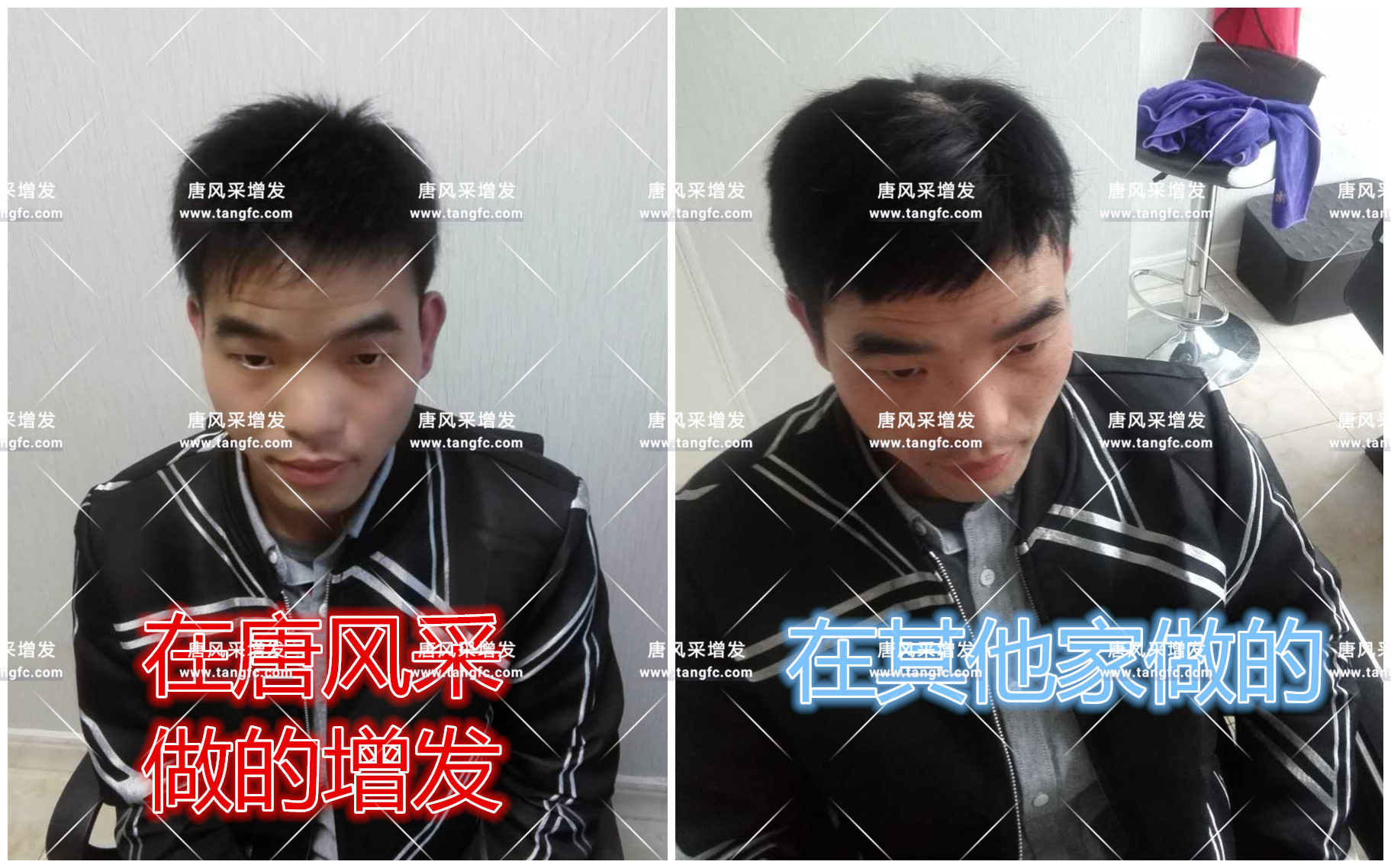 頭發(fā)稀疏 老天對年輕人開了一個(gè)很大的玩笑!